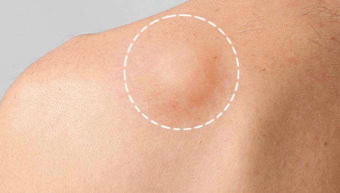 楊浩康(Yeung Ho Hong)醫生講解脂肪瘤(Lipoma)